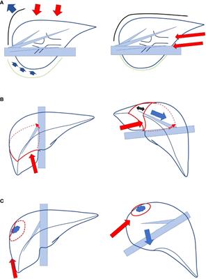 Caudal Approach to Laparoscopic Liver Resection—Conceptual Benefits for Repeated Multimodal Treatment for Hepatocellular Carcinoma and Extended Right Posterior Sectionectomy in the Left Lateral Position